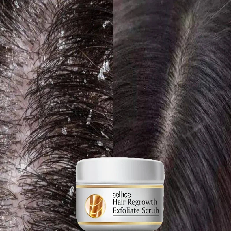 Hair Essence Oil Hair Oil Hair Growth Oil Anti Dandruff Hair Oil Control Relieve Itching Treatment Scalp Cleaning Exfoliating Product Antipruritic Anti Loss Hair
