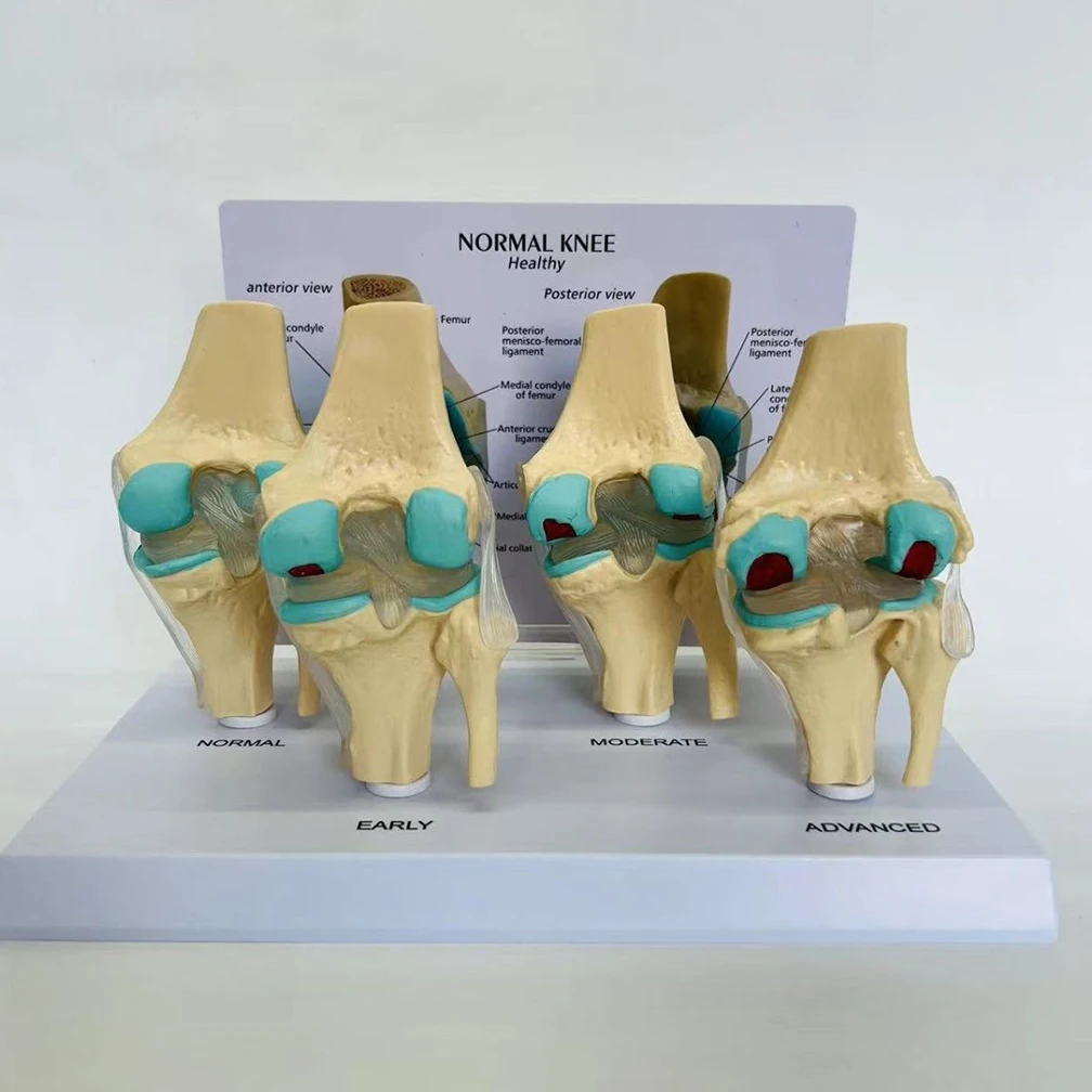 Four-Stage Human Pathological Knee Joint Anatomy Model Medical Science Teaching Resources Kit Models Dropshipping