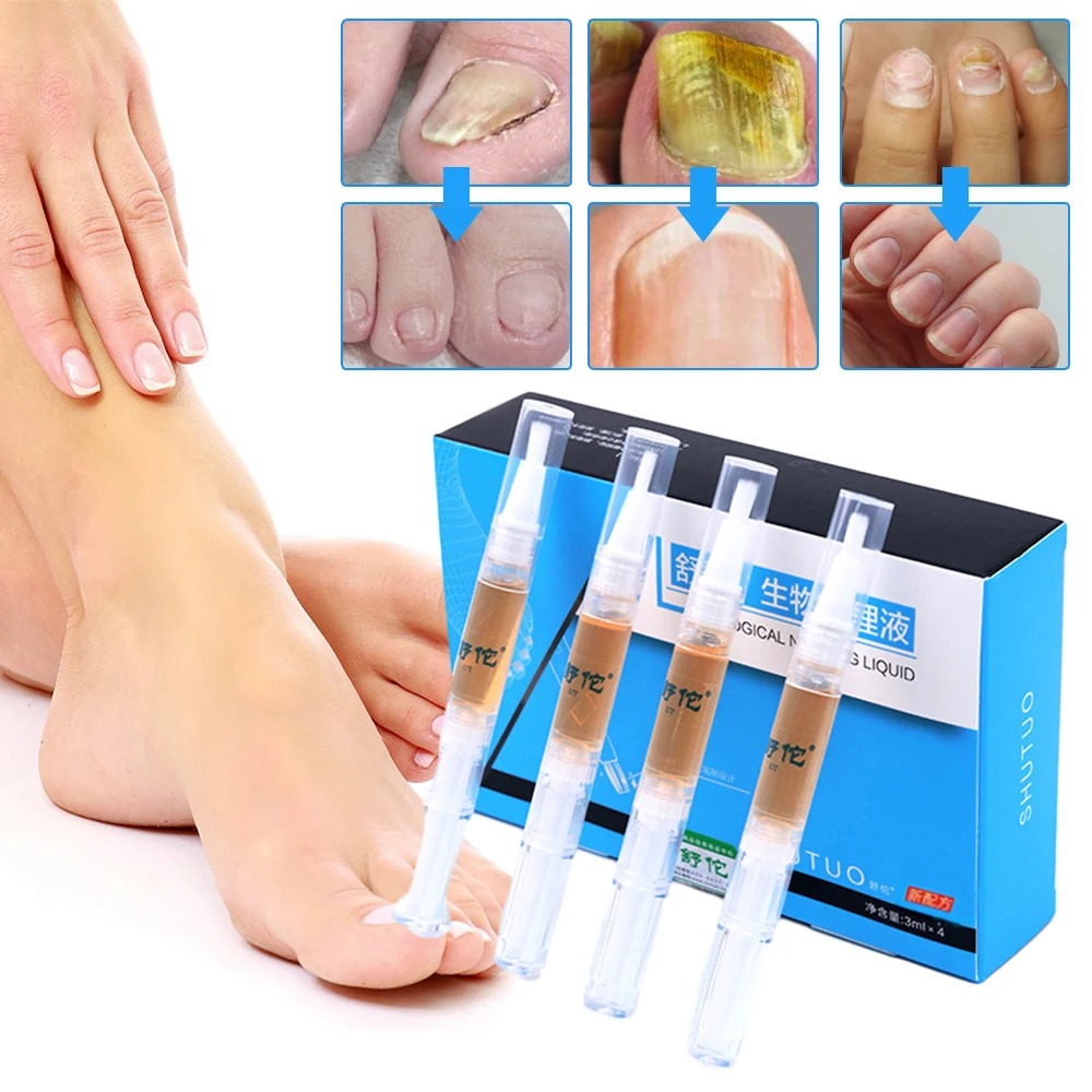 

4pc Nail Fungal Treatment Pen Anti Fungus Infection Biological Repair Liquid Solution Nutritious Oil Restores Healthy Toenails