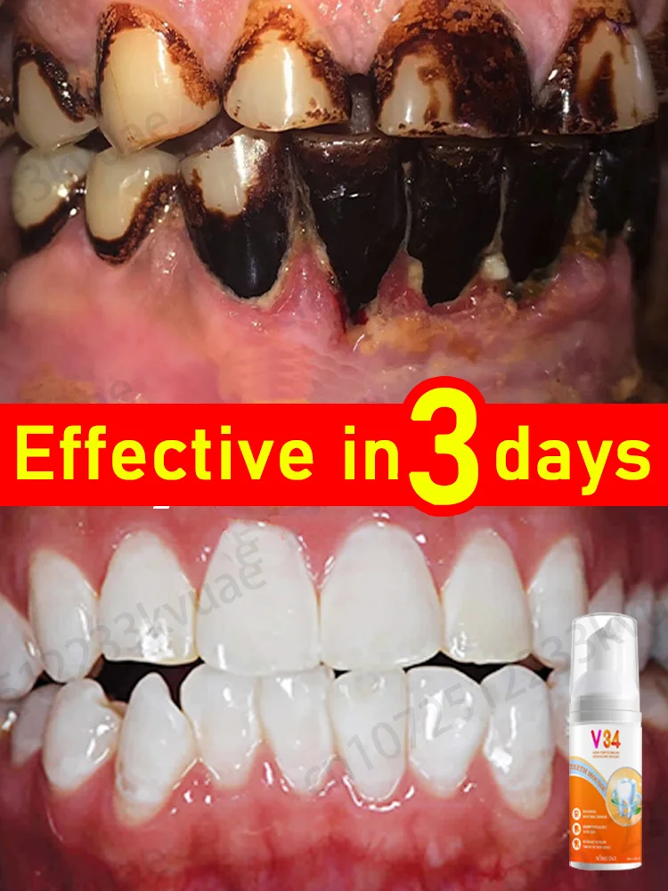 Teethwhiteningmousseremovestoothstainstobaccostainsdental