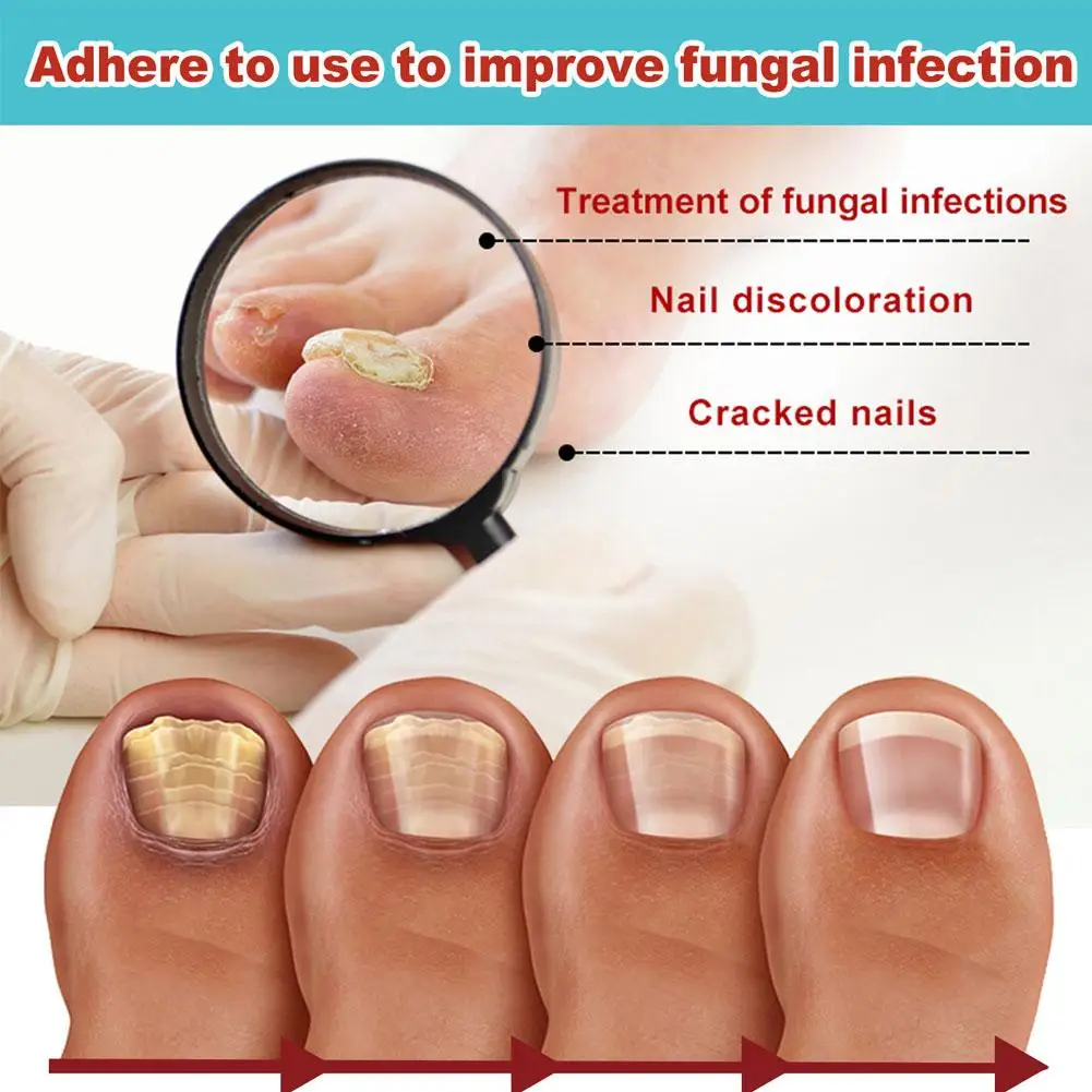 Nail Fungus Remover Toenail Fungus Treatment Nail Patches Anti Fungal Nail Correction Patch