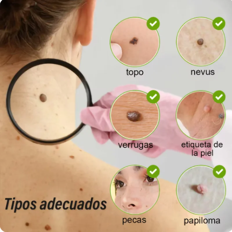 Plasma Pen Mole Blackhead Warts Dark Spot Black Acne Woman Dot Nevus Blemish Pimples Remover 15 Gears for Face Body Skin blackhead remover,skin tag removal tool,acne remover,facial pore cleanser,skin tag removal pen,laser skin treatment