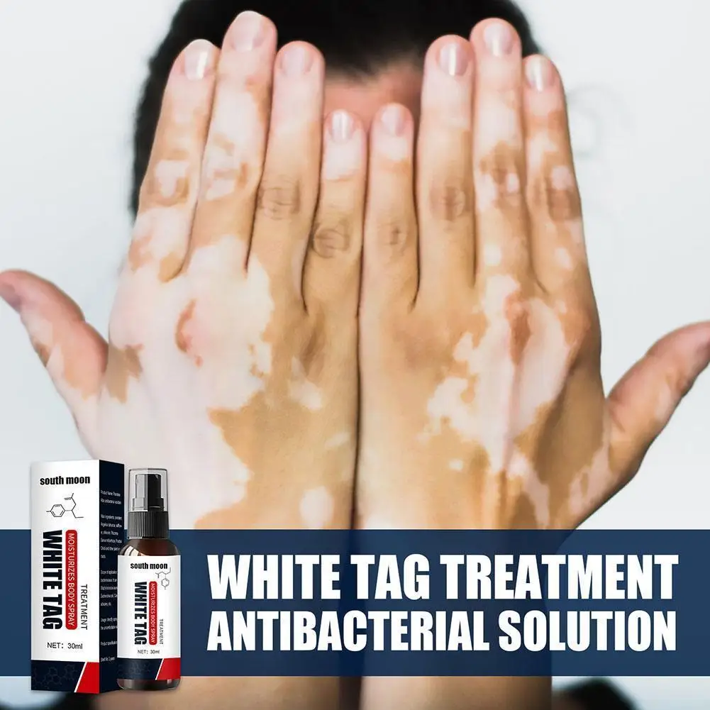 Vitiligo treatment cream Vitiligo relief spray Skin treatment lamp White Spot Removal vitiligo ointment Eliminate vitiligo ointment