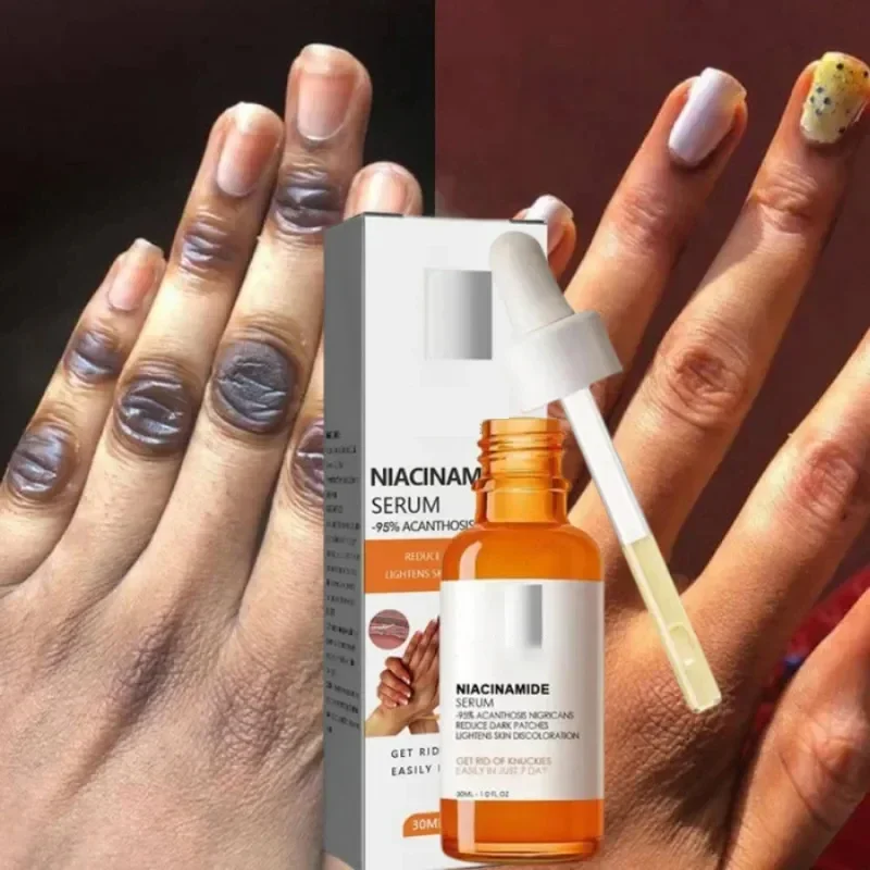Dark knuckles whitening serum Elbows Armpit Beaching SerumWoman Private Part Skin Removal Dark Knuckles Strong Whitening Serum