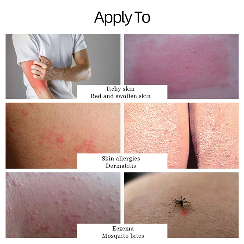 Dermatitis Atopica Antipruritic Medicine Cream Treatment Seborrheic Eczema Allergy Pruritus Medical Bacteriostatic Ointment