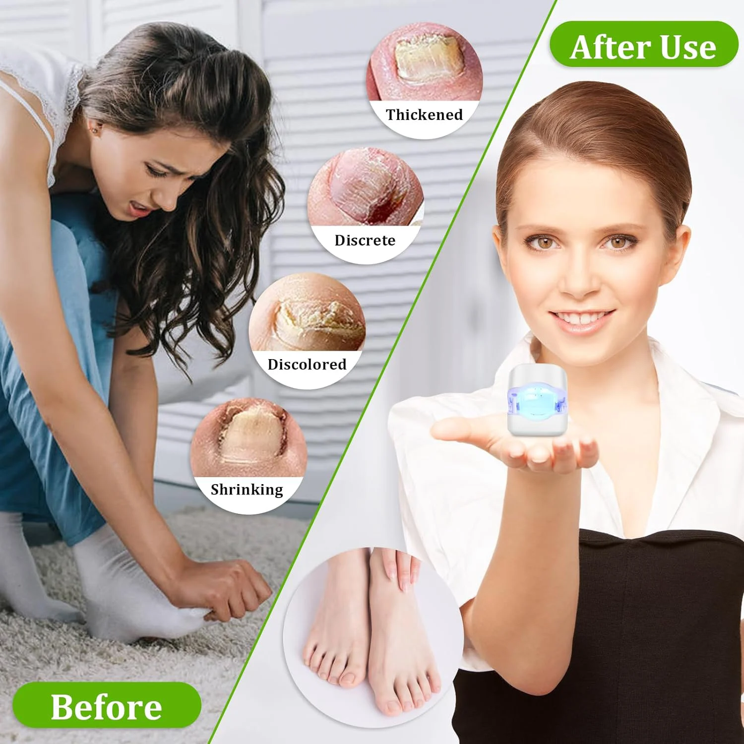 جهاز ليزر لتنظيف فطر الأظافر ، إزالة فطار الأظافر...