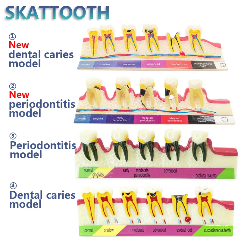 Dental Model Disease Tooth Model Tooth Dental Teaching Model for Dentist Teaching Training Learning Doctor-patient Communication