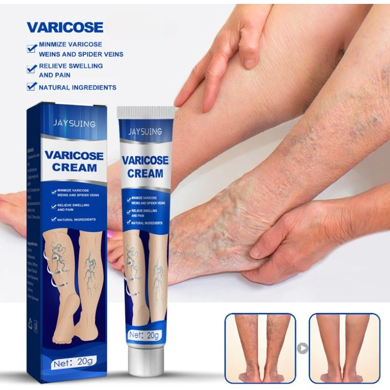 Pomada-para-al-vio-das-varizes-creme-eficaz-para-aliviar-a-vasculite ...