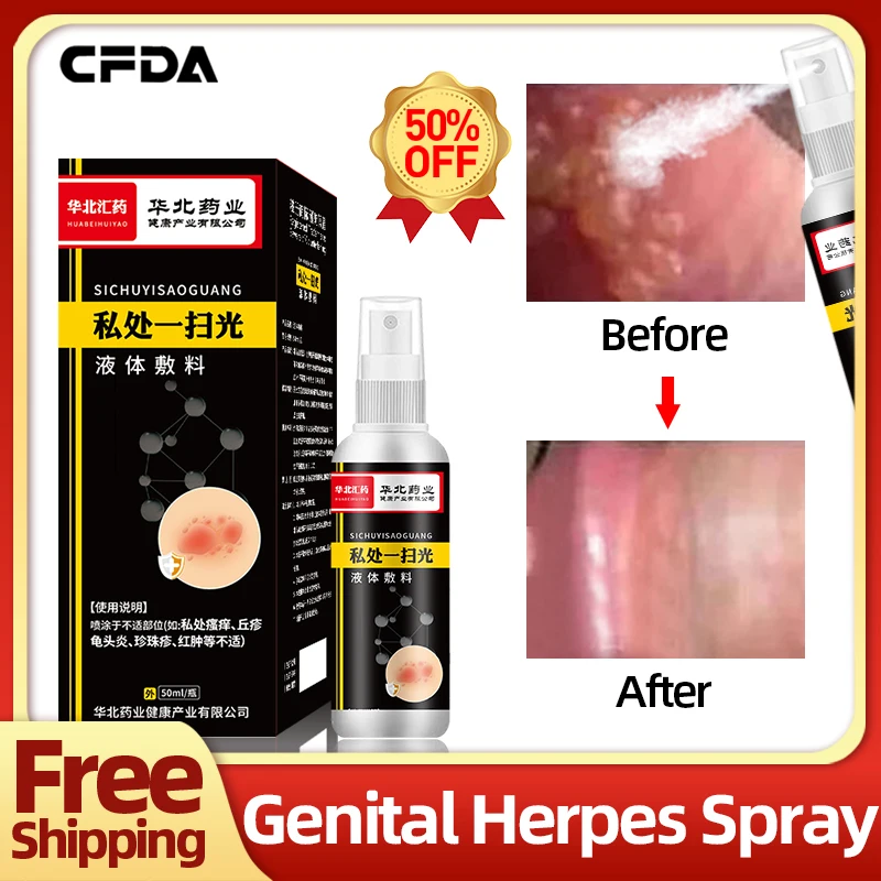 Herpes Spray Chinese Medicine Genital Herpes Simplex Cure for Men and Women 50ml/bottle CFDA Approval Shingles Treatment Cream