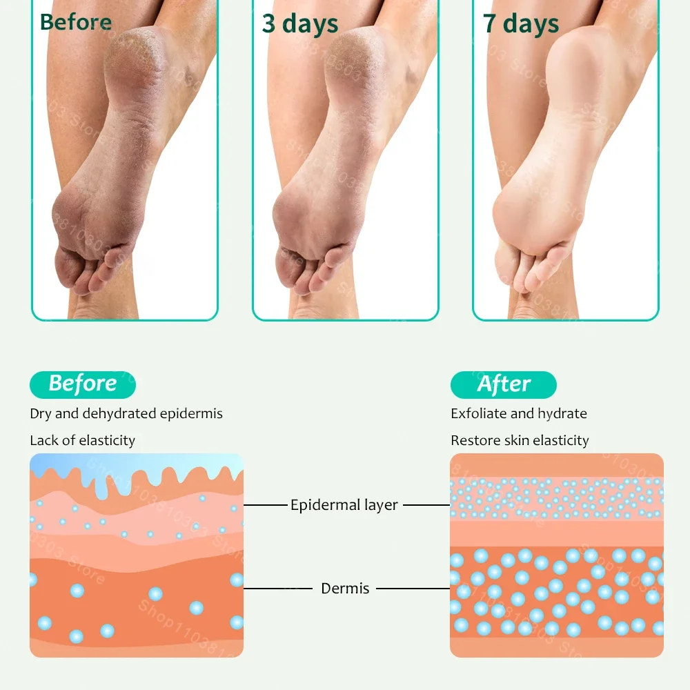 100g Urea 40% 42% Anti-Drying Crack Foot Cream Heel Cracked Repair Removal Dead Skin Hand Moisturizing Exfoliating Heel Mask