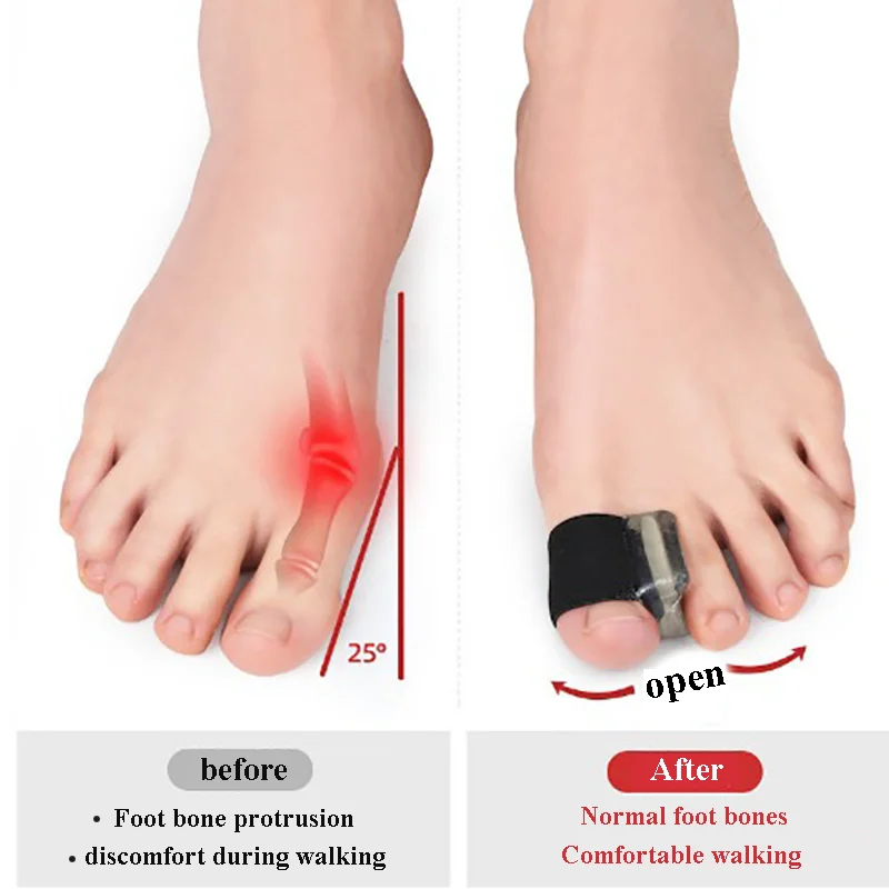1/2/4Pc TwoToe Separator Hallux Valgus Bunion Corrector Orthotics Feet Bone Thumb Adjuster Correction Pedicure Feet Straightener toe separator bunion corrector toe corrector thumb eversion corrector