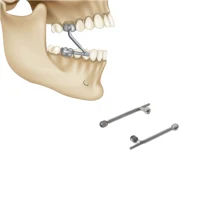 Appareil Herbst monté buccale fixe non amovible avec saut de morsure occlusal pour dispositif orthodontique de précision de Correction de classe II 5
