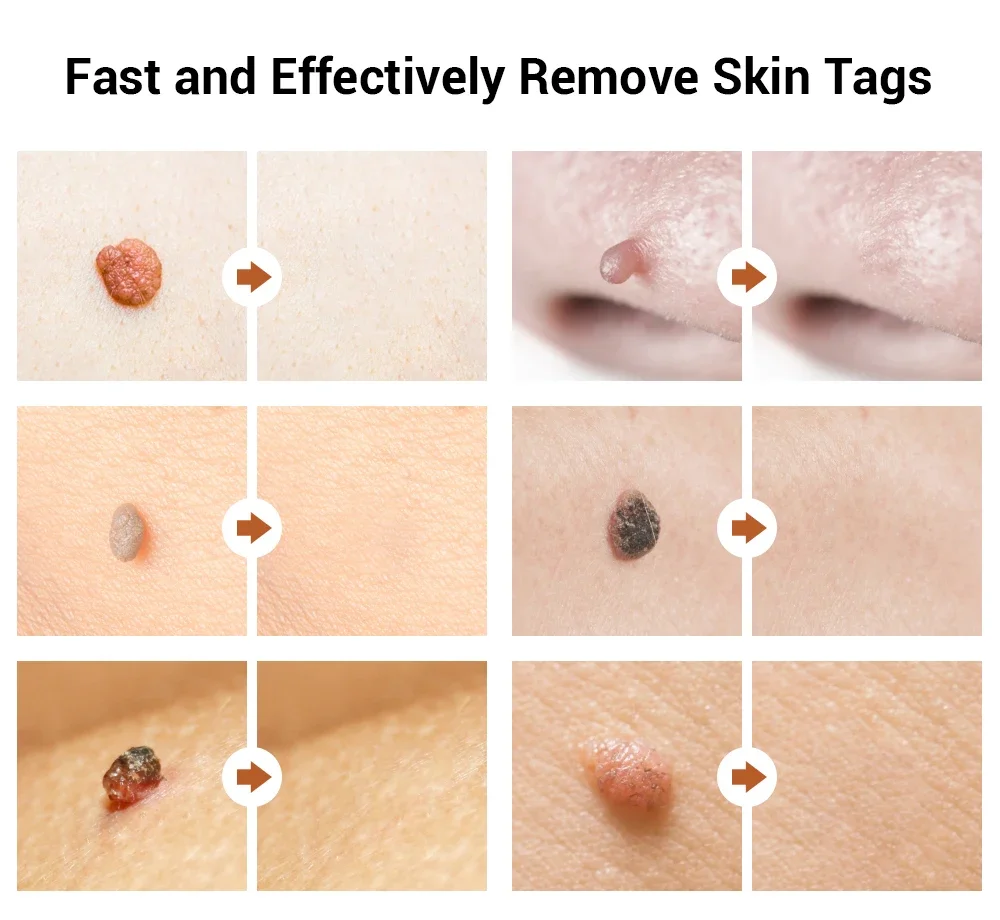 Skin Tag Remover Electric Laser Plasma Pen Black Dot Papilloma Wart Remover Dark Spot Mole Warts Eliminator Lcd Plasma Pen