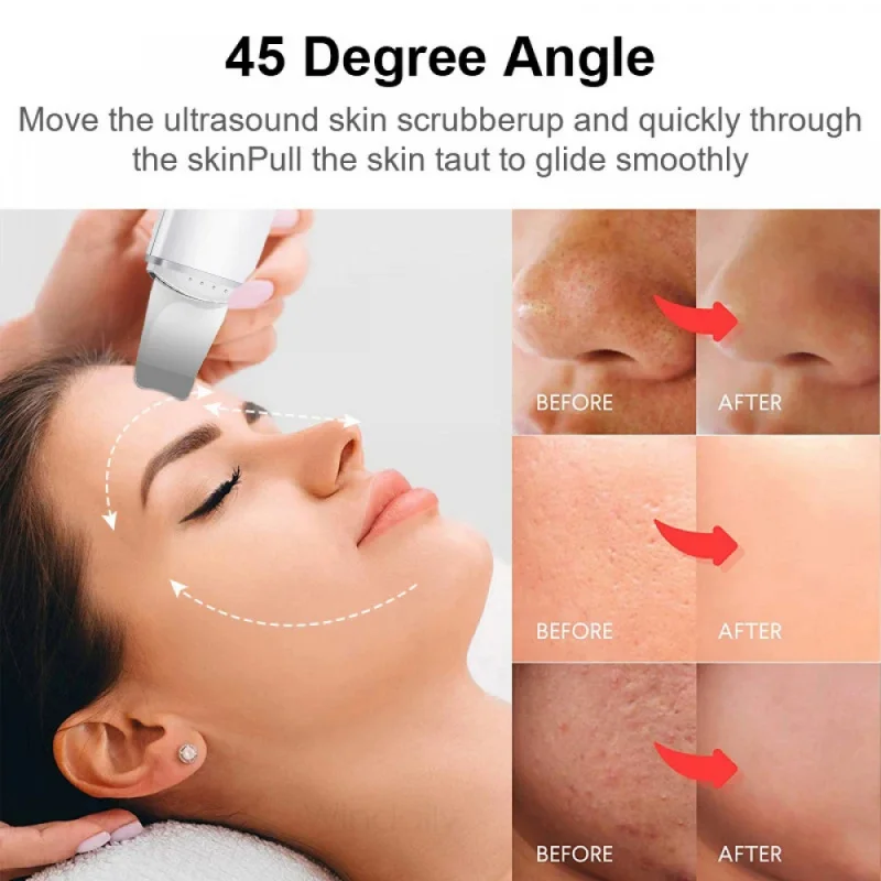 Ultrasonic Skin Care Spatula Vibration Blackhead Remover Cavitation Shovel Facial Exfoliation Skin Care Tools blackhead remover