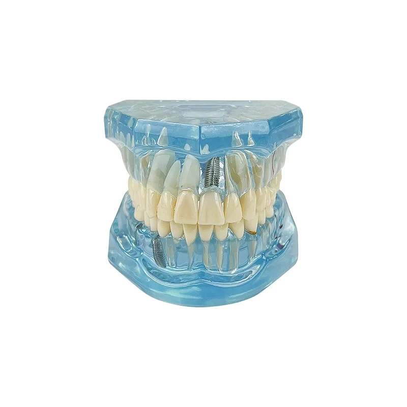 VVDental 치과 질환 치아 모형 치과 질환 교육용 연구 모형 의학용 수복 브릿지 치아 포함