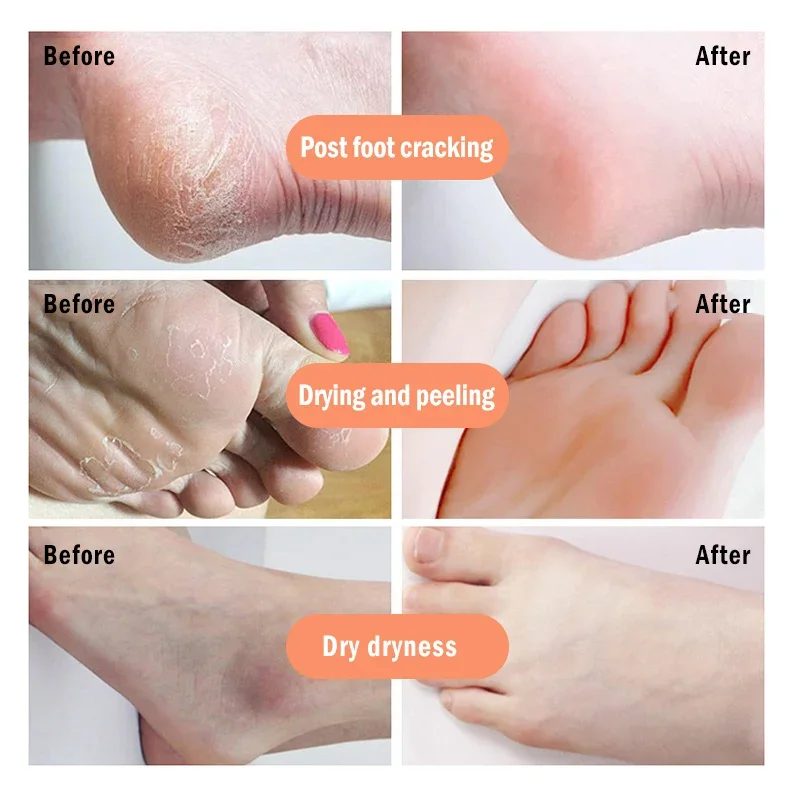 Anti-Drying Crack Foot Cream Heel Cracked Repair Cream Banana Oli Moisturizing Removal Dead Skin Hand Feet Smooth Care 각질제거 pain analgesic cream