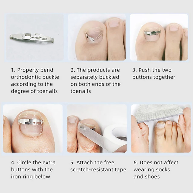 Strumenti per la correzione dell'unghia del piede incarnita Pedicure Recupera nel trattamento delle unghie dei piedi incorporati Strumento professionale per la cura del piede per la correzione dell'unghia del piede incarnita 5