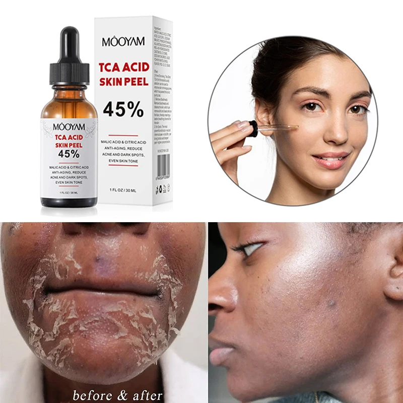 TCA 45 Chemical Peel Tca Peel Acid Peeling Acid 7 15 Days Delivered
