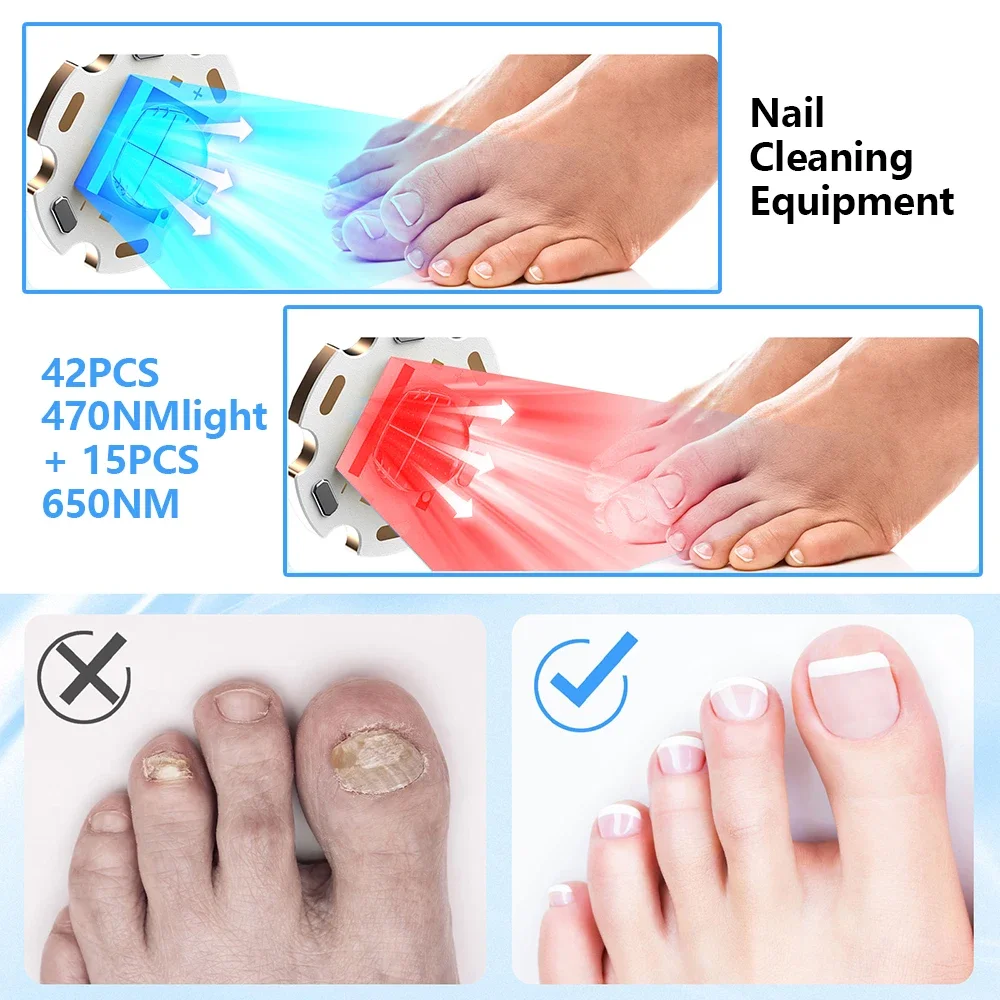 Nail Fungus Laser Treatment Device Repair Toenail Fingernail Fungus Treat Onychomycosis Laser Nails With Mushrooms Remove