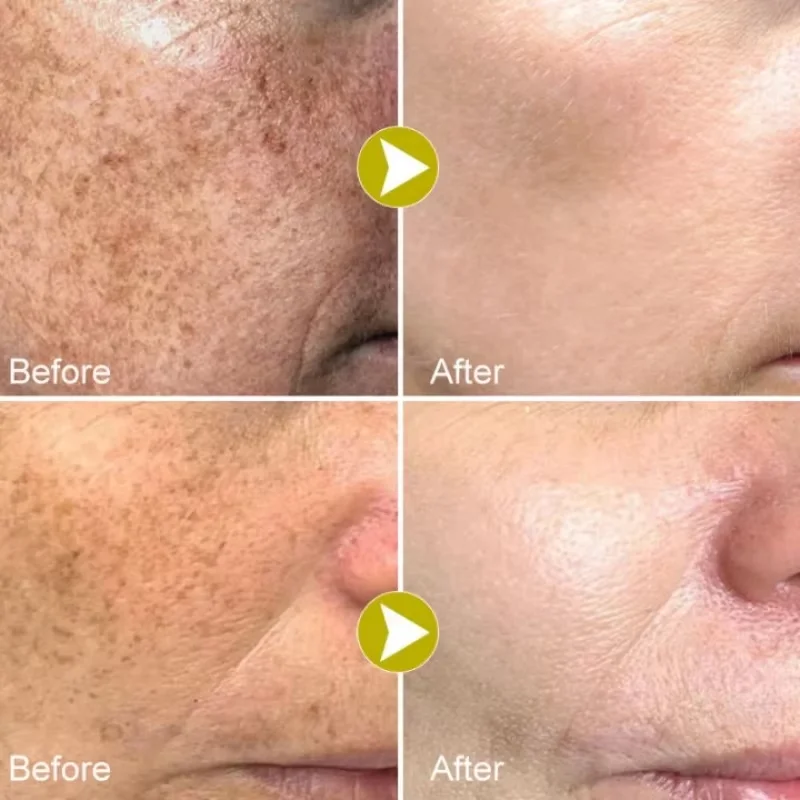 Nicotinamide Whitening Freckles Serum Face Dark Spot Remover Vitamin C Lightening Melanin Blemish Moisturizer Brighten Skin Care 2
