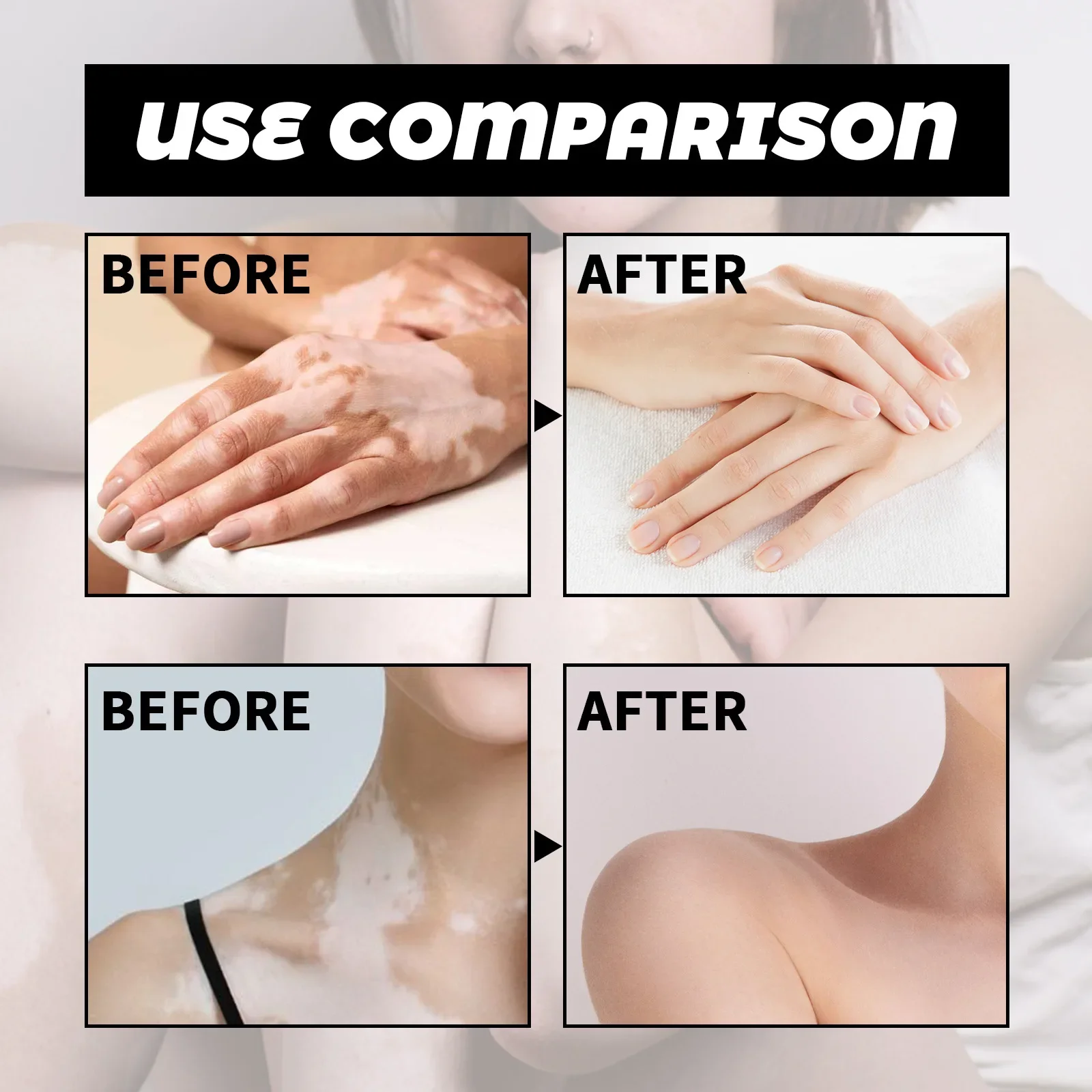 Spray anti-Vitiligo, élimine les taches blanches de la teigne, élimine les taches de sueur, traitement de la leucoplasie, répare, hydrate la peau, liquide de soin_voghion.com