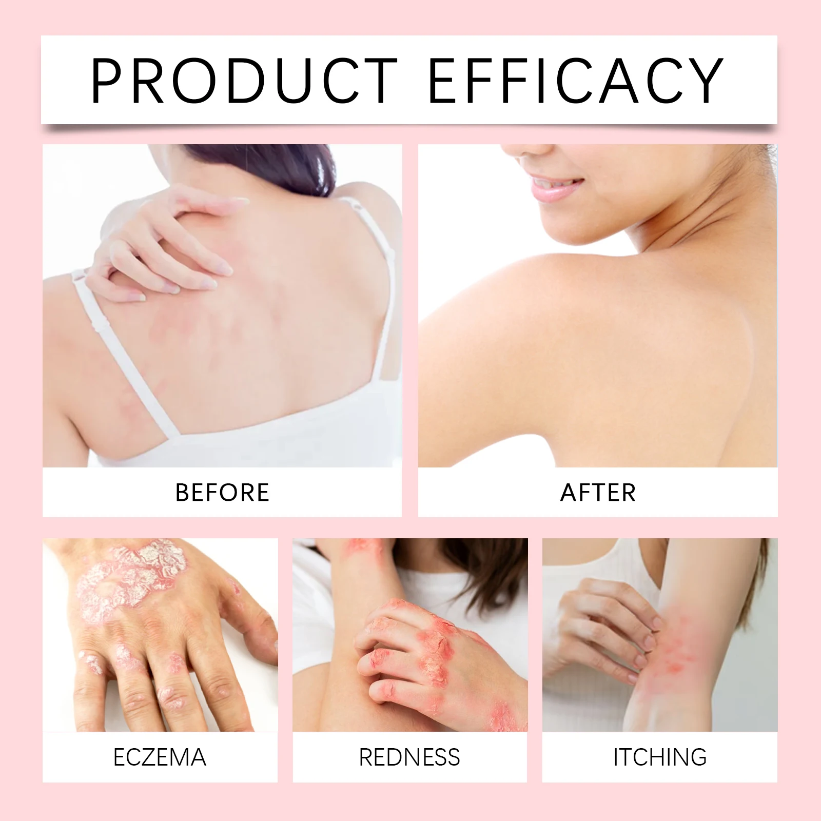 Repair Psoriasis Ointment Relieve Skin Itch Dryness Rash Desquamation Anti Fungus Treat Folliculitis Urticaria Hypersensitivity