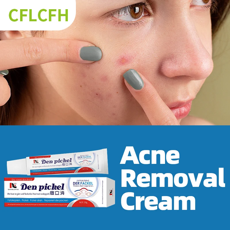 

Acne Treatment Cream Pimple Face Care Anti Acne Marks Removal Ointment Blackhead Remover Shrink Pores German Secret Recipe