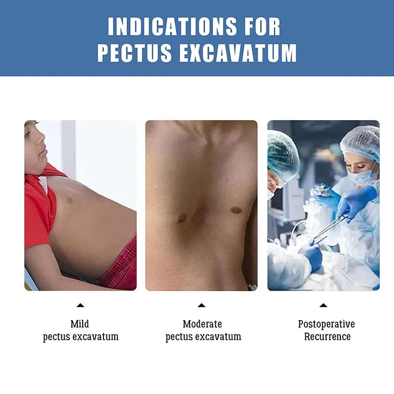 GHORTHOUD Rehabilitation Equipment Funnel Chest Orthopedic Brace Pectus Excavatum Brace Vacuum Bell Pectus Excavatum 3