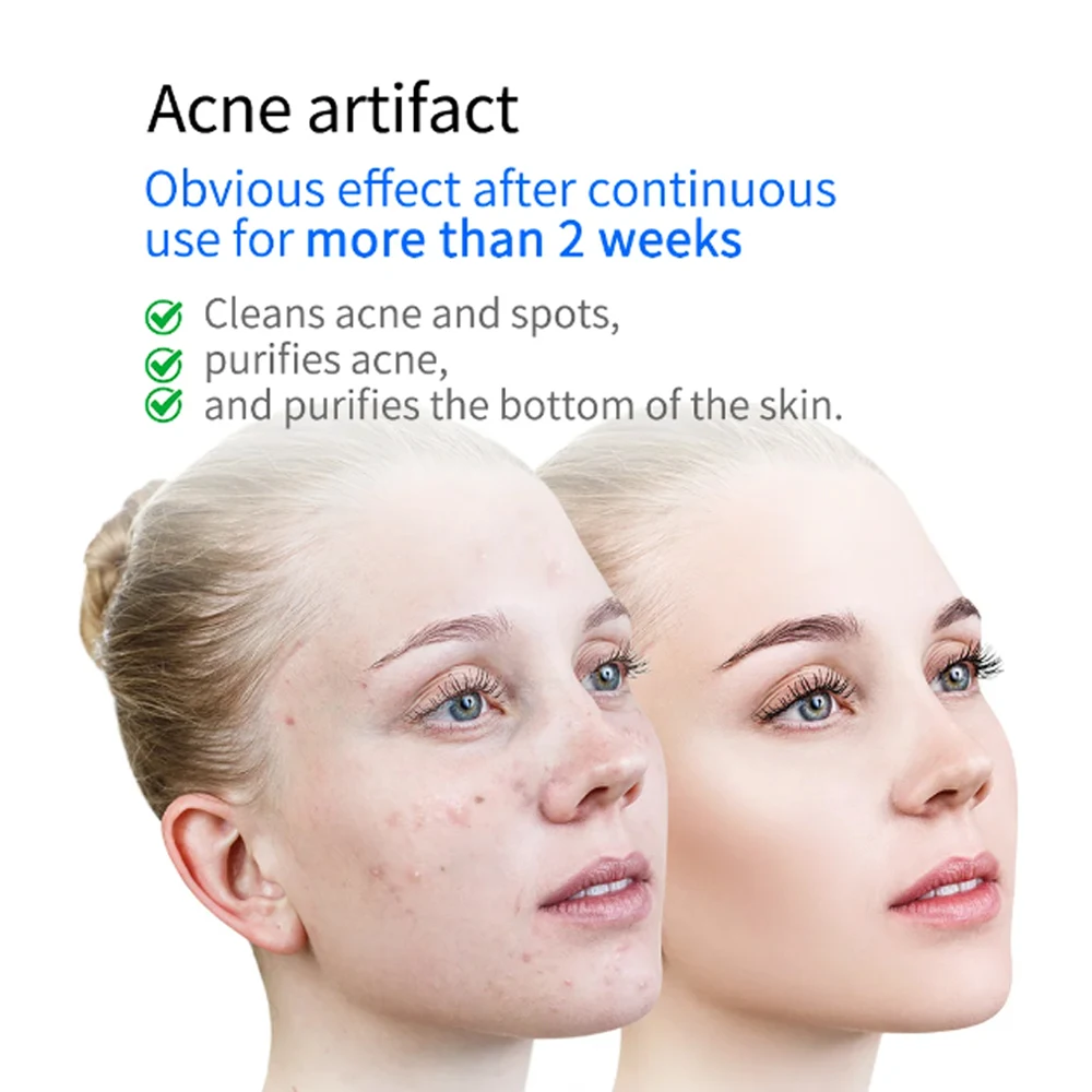 KinseiBeauty Plasma Skin Care Beauty Machine Ozone Acne Remove Anti-acne Sterilization Skin Brightening Face Massagers Devices