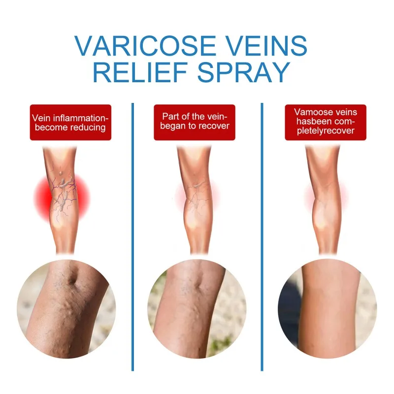Spray for Varicose Veins Effective Varicose Vein Relief Cream Relieve Leg Vasculitis Phlebitis Spider Pain Swelling Treatment
