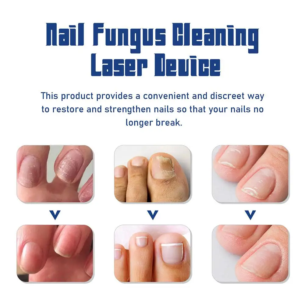 Nail Fungus Laser Treatment Device Fungal Treatment Anti Infection