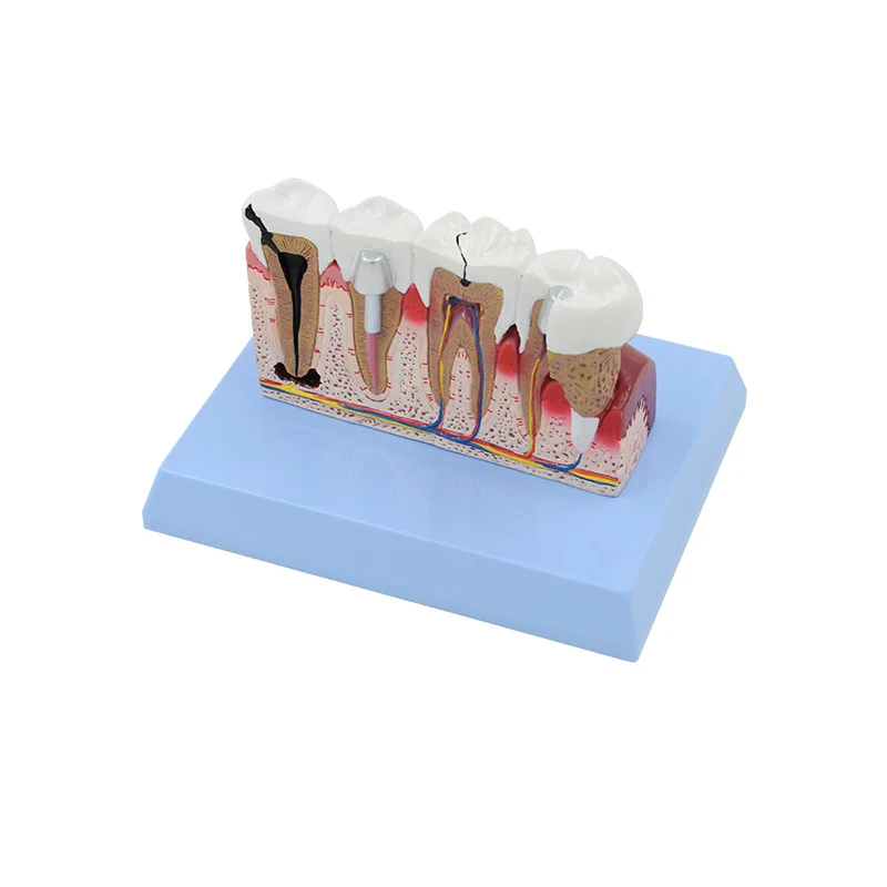Tooth Dental Pathology Anatomy Model Medical Science Teaching Resources
