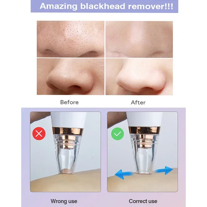 Blackhead Remover Acne Remover Facial Pore Cleanser Electric Blackhead Remover Vacuum Pore Cleaning Facial Black Spots White Dot Pimple Acne Cleaner Face Care Tool Beauty
