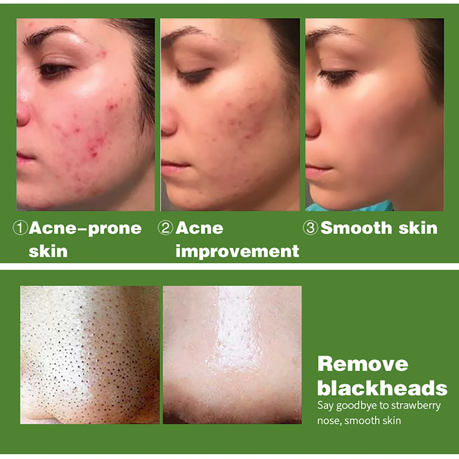 AILKE Salicylic Acid Acne Treatment Serum, Effective Control Acne Marks ...