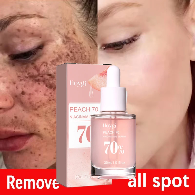 Niacinamide Whitening Freckles Serum Removal Melasma Dark Spots