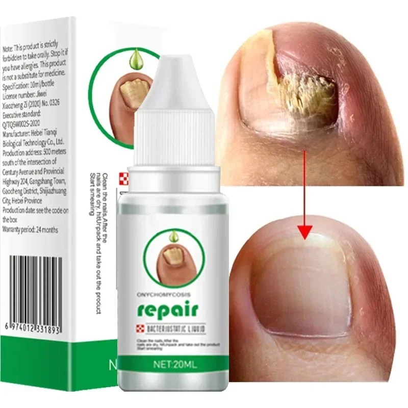 

Nail Fungus Treatment Serum Toe Fungal Repair Products Hand Foot Care Removal Gel Anti Infection Onychomycosis Paronychia