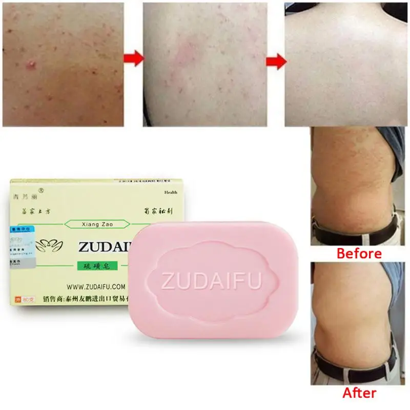 

1~10PCS Zudaifu Sulfur Soap Cleanser Oil-Control Cure Face Whitening Sulfur Soap Skin Peel Cleanser Handmade Soap