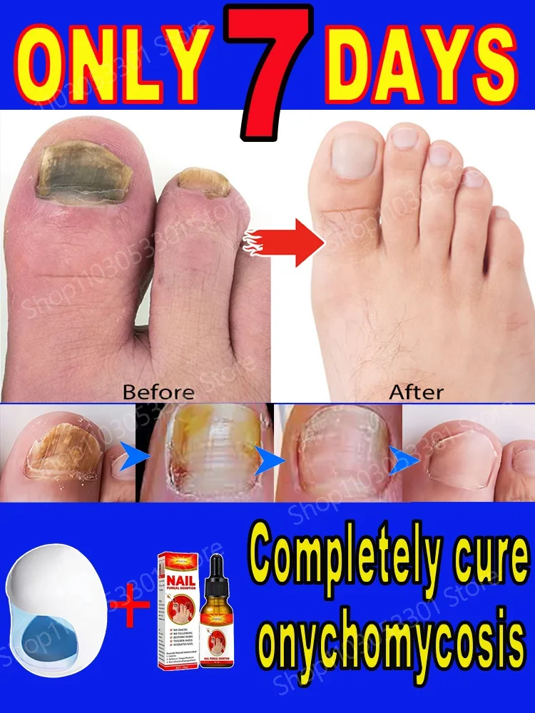 Onychomycosis ointment + laser treatment device for complete treatment, rapid treatment of onychomycosis and care of foot health