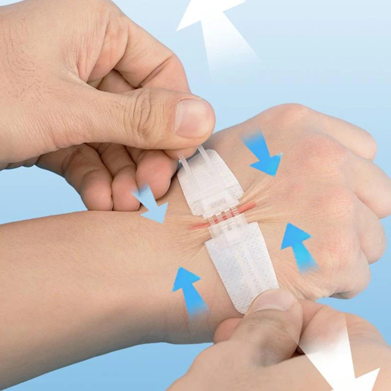 Portable Zipper Tie Wound Closure Patch Hemostatic Patch Wound Fast Without Suture