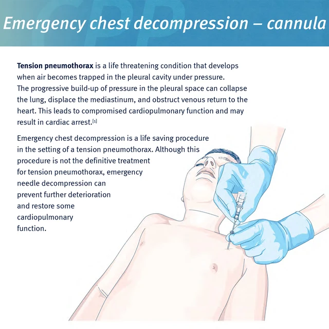 Sanke Rescue Pneumothorax Needle Trauma Medical Ifak Chest Cathether Needlecatheter 50g Needle Decompression Edc First Aid Kit 5