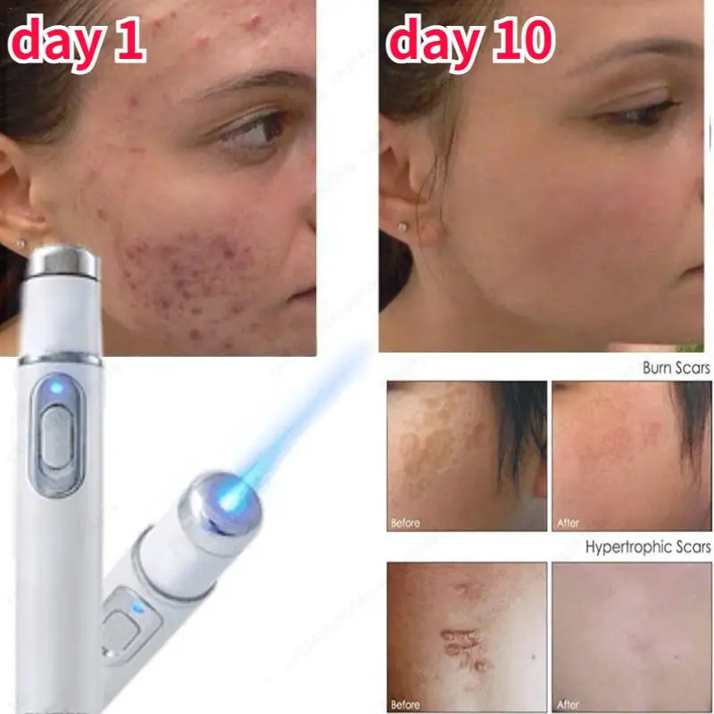 For Acne Laser Pen Portable Wrinkle Removal Machine Soft Scar Remover Device Blue Light Therapy Pen Massage