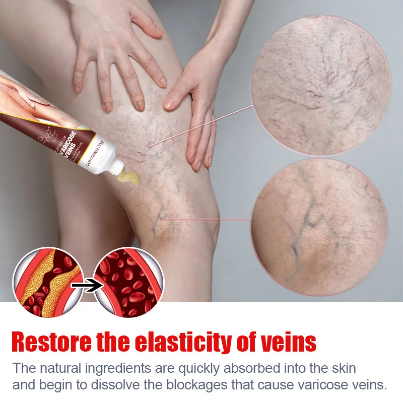 20g Varicose Vein Relief Cream Improves Blood Circulation Relaxing Leg Cream Relieve Spider Blood Vessels Anti Varicose pain analgesic cream varicose veins patch
