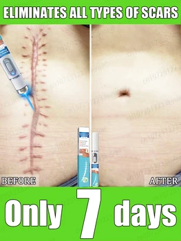 Rimozione delle cicatrici laser, adatta a tutti i tipi di cicatrici, rimozione delle cicatrici sicura e sana 1
