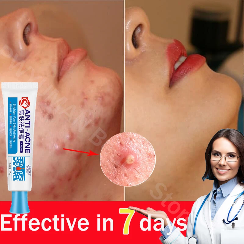 

Natural Anti Acne Pimple Treatment Cream Face Whiten Black Dots Butt Acne Mark Remover Shrink Pore Moisturizer Korean Cosmetics