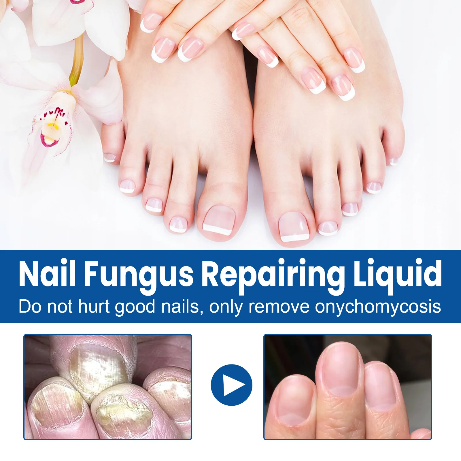30ML Fungal Nail Treatment Removal Oil Foot Fungus Repair Essence Toe Fungus Removal Gel Anti Infection Best Essenice 발톱무좀