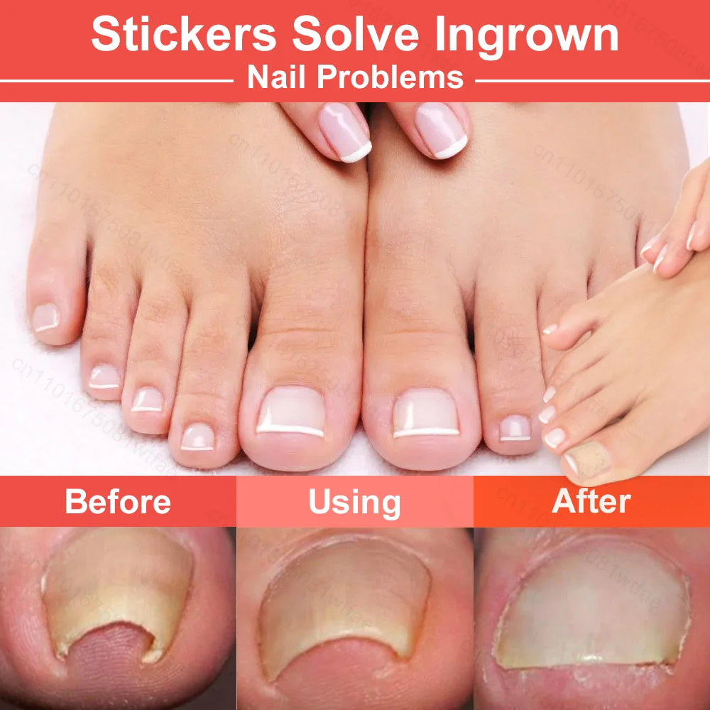 Toenail Fungus Treatment Patches Ingrown Correction Waterproof Sticky Nail Repair Sticker Discolored Damaged Fungal Nails