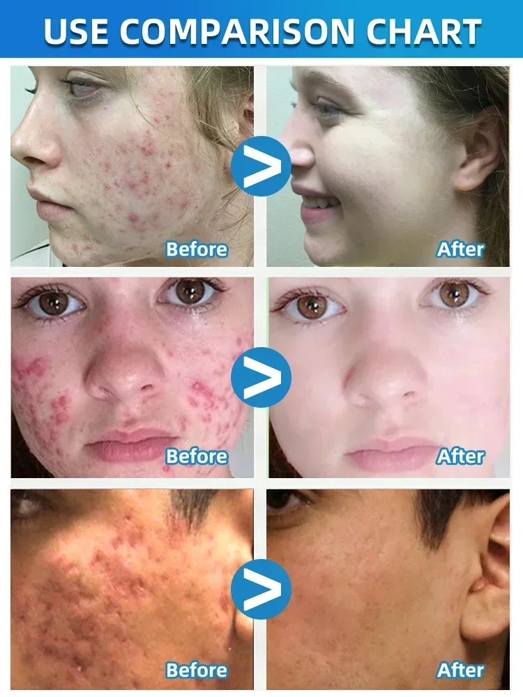 Salicylic Acid  Solution Essence Shrink pores and Acne Spot Removing Shrink Pores Oil-Control Brighten Face Skin Makeup 4