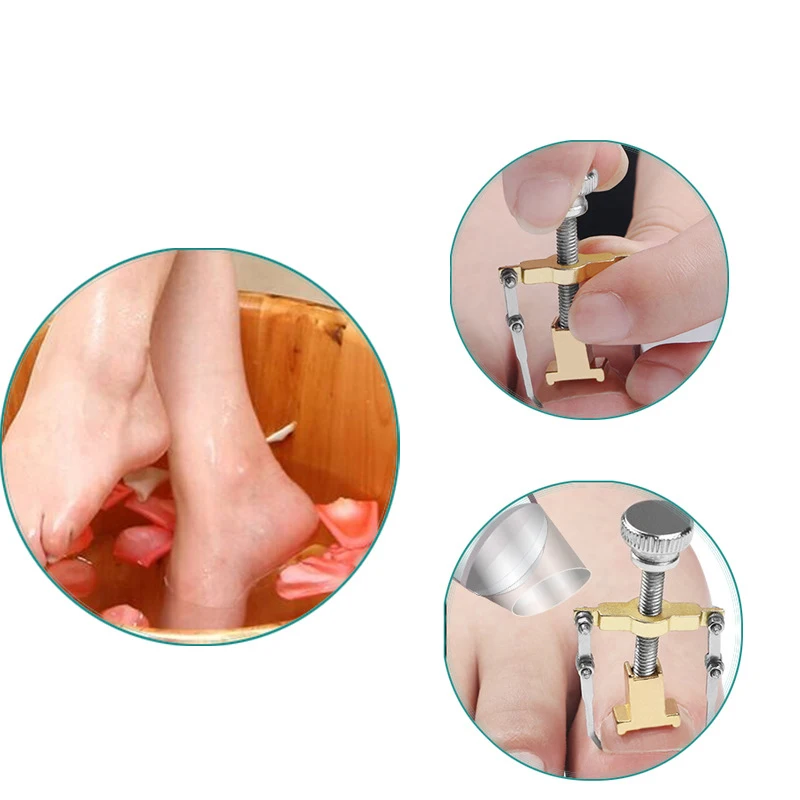 1pc Correction of Paronychia with Toe Nail Correction Bracket for Treatment of Toe and Toe Care with Toe Fixator 3