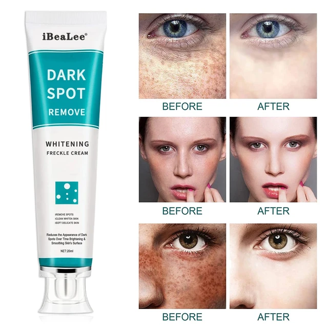 iBeaLee Whitening Freckle Cream Remove Melasma Acne Spot Pigment Melanin Dark Spots Whitening Moisturizing Cream Skin Care 2