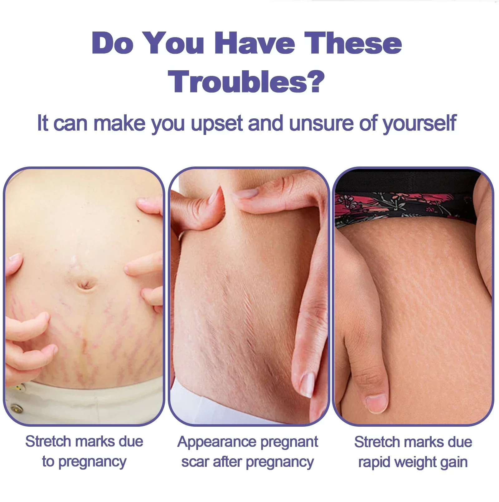Stretch Mark Removal Cream Postpartum Repair Cream For Pregnant Women Obesity Mark Growth Thigh Tightening